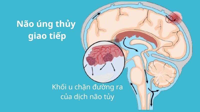 Bệnh hình thành do giảm hấp thu dịch não tủy qua đám rối mạch mạc