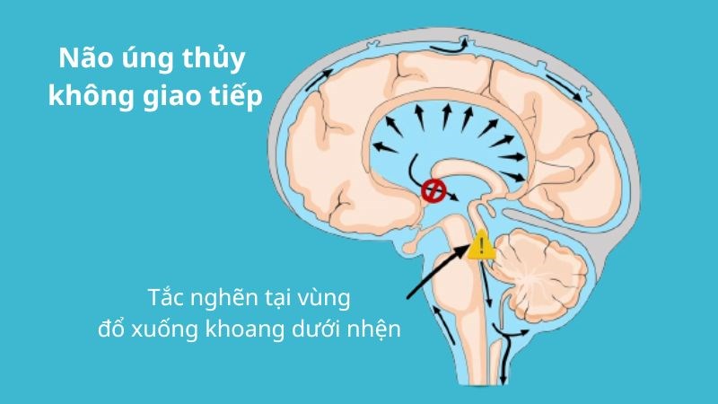 Dịch não tủy bị chặn ở vị trí các não thất
