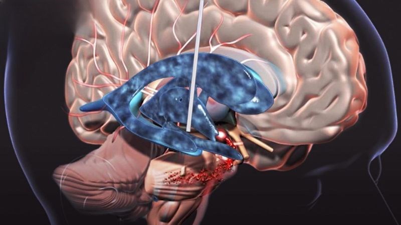 Phẫu thuật phá sàn não thất III để chuyển hướng dòng chảy dịch não tủy