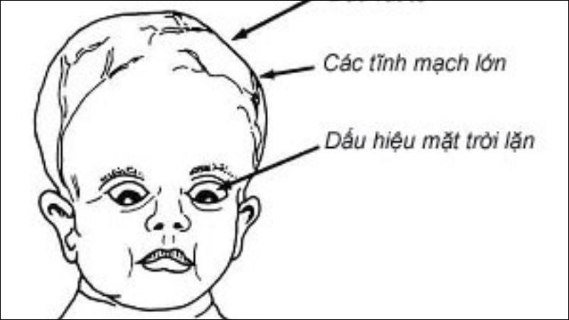 Dấu hiệu mặt trời lặn là dấu hiệu đặc trưng của trẻ não úng thủy