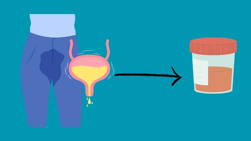 Sau mổ có thể dẫn tới rò niệu quản gây ra tiểu máu