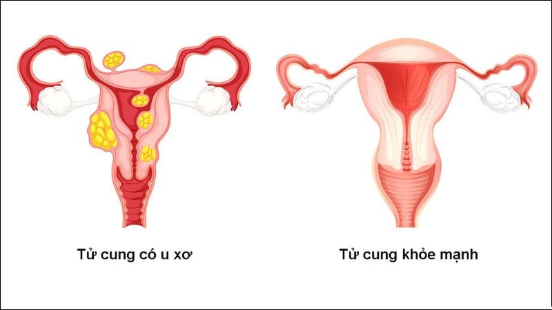 Mổ u xơ để ngăn cản sự phát triển của khối u chèn ép các tạng