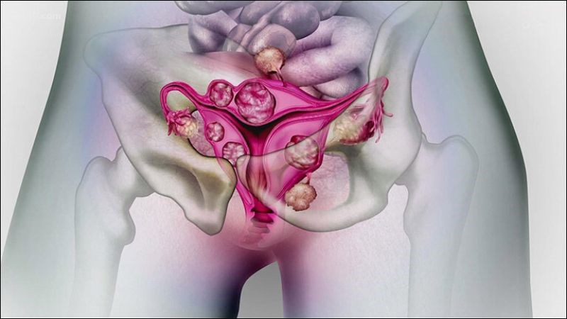 Loại bỏ u xơ kích thước lớn để giảm những biến chứng nguy hiểm đến các cơ quan khác