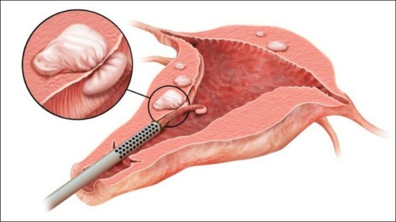 Bóc tách nhân xơ được chỉ định cho phụ nữ còn mong muốn có con