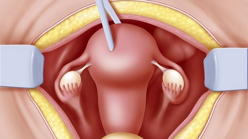 Trường hợp u xơ tử cung lớn có thể phải cắt toàn bộ tử cung