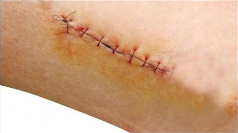 Sau mổ nếu không chăm sóc kỹ vết mổ sẽ dẫn tới nhiễm trùng
