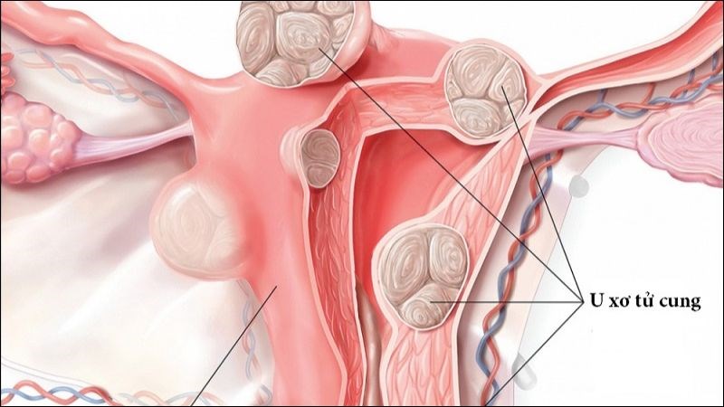 Phẫu thuật bóc tách u xơ có thể còn sót lại các khối u xơ nhỏ gây tái phát u xơ tử cung