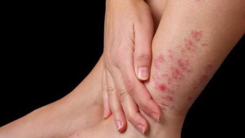 Ăn mít gây dị ứng do di truyền hoặc do cơ thể nhận diện nhầm protein trong mít