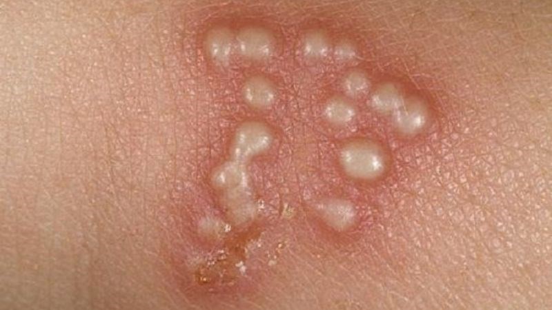 Rau diếp cá có khả năng ức chế sự phát triển của virus herpes