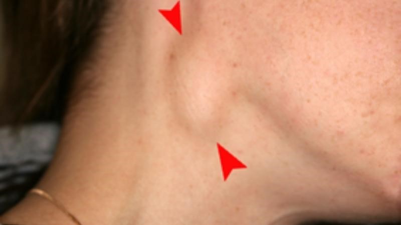 Ung thư máu loại lymphoma có thể liên quan đến yếu tố di truyền từ mẹ sang con