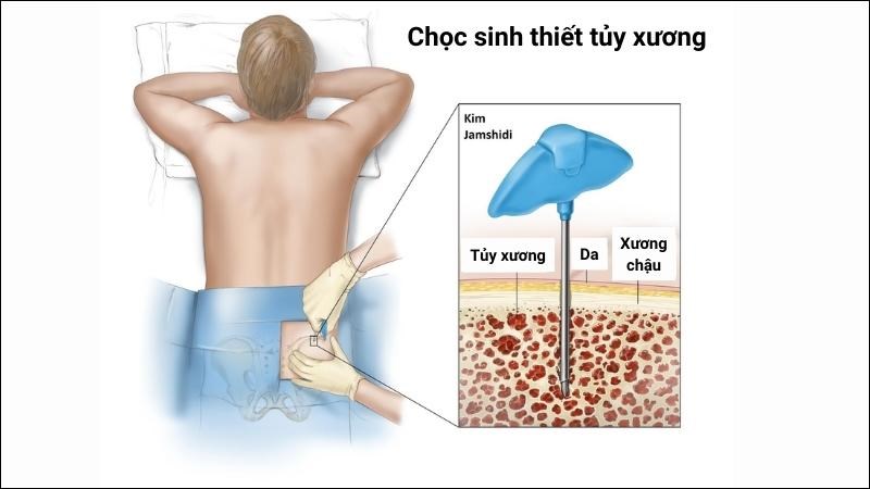 Sinh thiết tủy xương giúp đánh giá số lượng và chất lượng tế bào tạo máu ở tủy xương