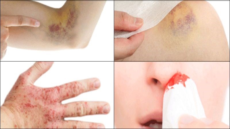 Khi có các biểu hiện của ung thư máu, bạn cần phải đến gặp bác sĩ sớm nhất