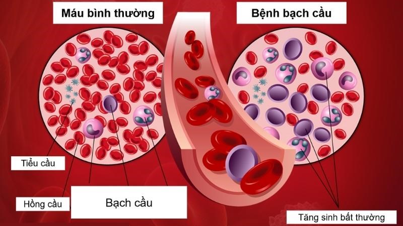 Bệnh bạch cầu được đặc trưng bởi sự gia tăng bất thường tế bào bạch cầu ác tính