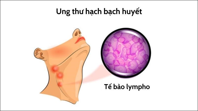 Lymphoma hay còn gọi là ung thư hạch bạch huyết