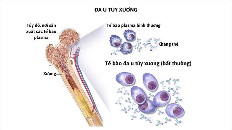 U tủy gây phá hủy cấu trúc và chức năng của tủy xương