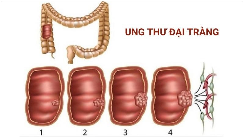 Ung thư đại tràng là loại ung thư có nguồn gốc từ đại tràng