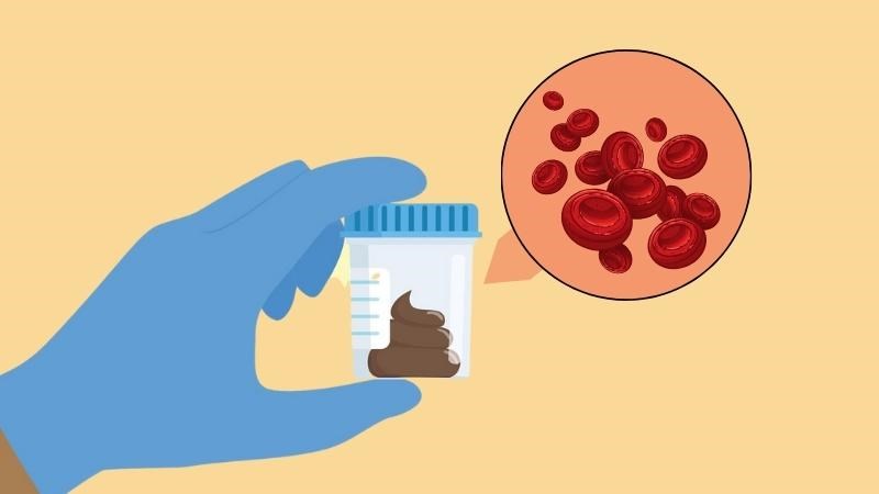 Xét nghiệm tìm máu ẩn trong phân giúp phát hiện máu ở trong phân dù rất ít