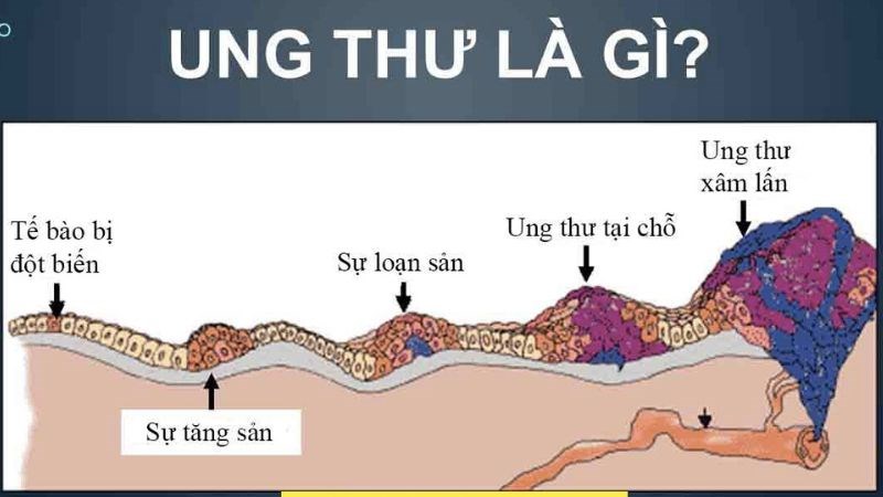Ung thư là sự biến đổi gen và phát triển không kiểm soát của các tế bào
