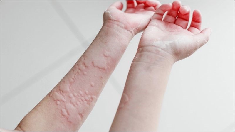 Người có tiền sử dị ứng cần thận trọng khi sử dụng aspirin