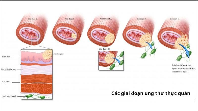 Ung thư thực quản được chia thành 4 giai đoạn tương ứng với sự tiến triển của khối u