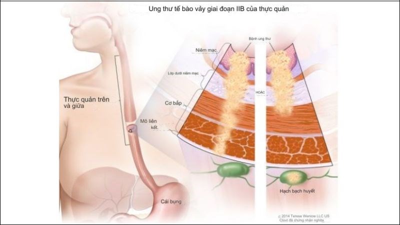 30% người bị ung thư thực quản giai đoạn 2 có thể sống sót từ 5 năm trở lên