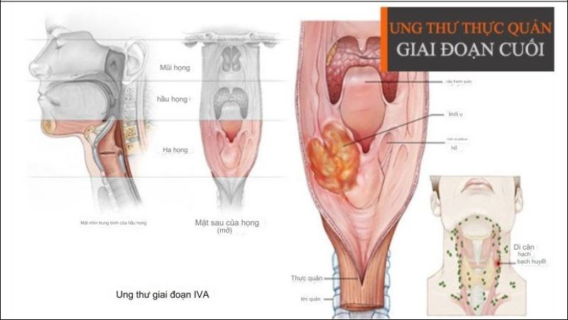 Khoảng 20% người bị ung thư thực quản giai đoạn 4 có thể sống sót từ 1 năm trở lên