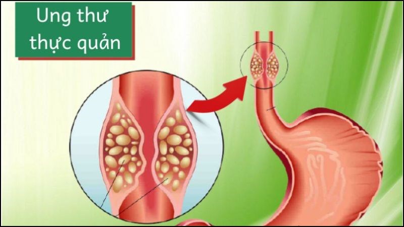 Ung thư thực quản là loại ung thư xuất hiện trong thực quản