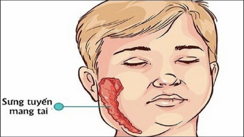 Bệnh quai bị do virus quai bị gây viêm tuyến nước bọt mang tai