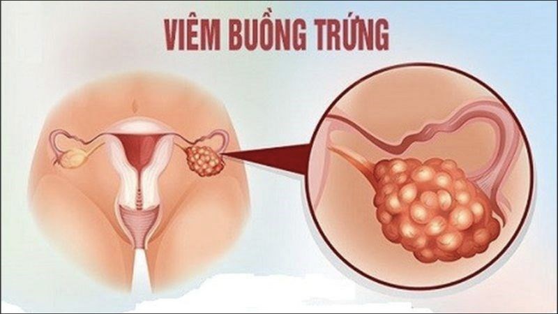 Quai bị có thể gây biến chứng viêm buồng trứng ở nữ giới