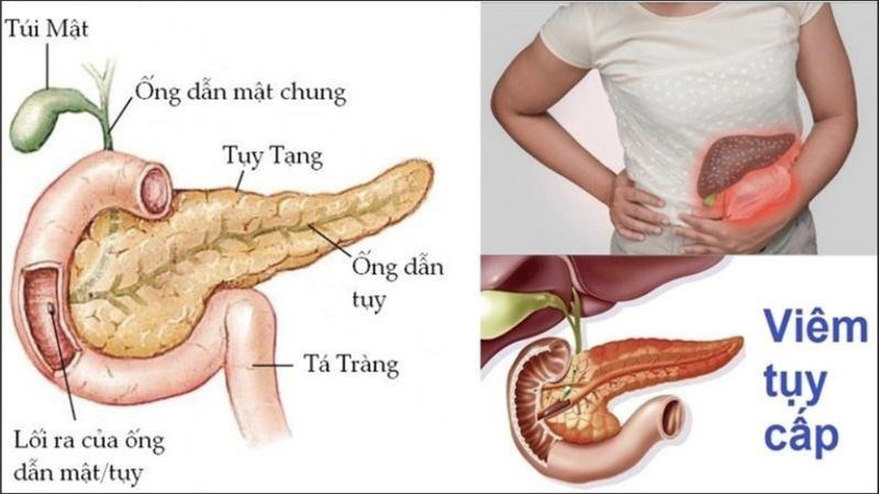 Bệnh viêm tuỵ gây đau thượng vị, đau dữ dội, buồn nôn, đầy bụng, tiêu chảy