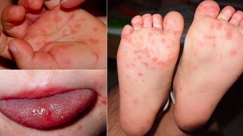 Bệnh tay chân miệng là một căn bệnh phổ biến và ảnh hưởng nghiêm trọng đến trẻ em