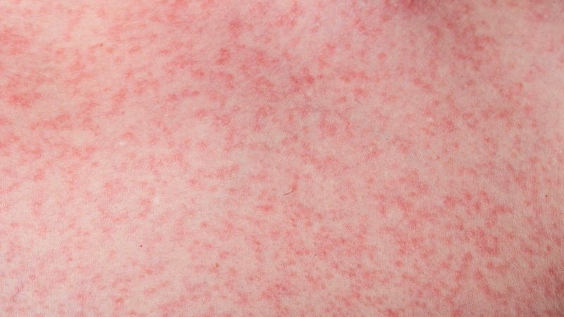 Phát ban là một trong những triệu chứng phổ biến của sốt xuất huyết