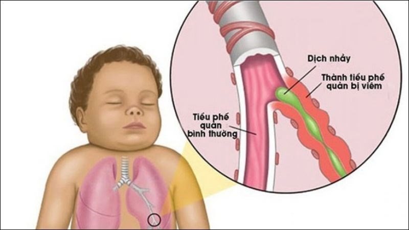 Viêm tiểu phế quản có thể gây suy hô hấp