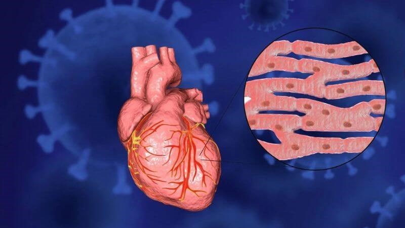 Viêm cơ tim là một biến chứng nguy hiểm khi nhiễm siêu vi