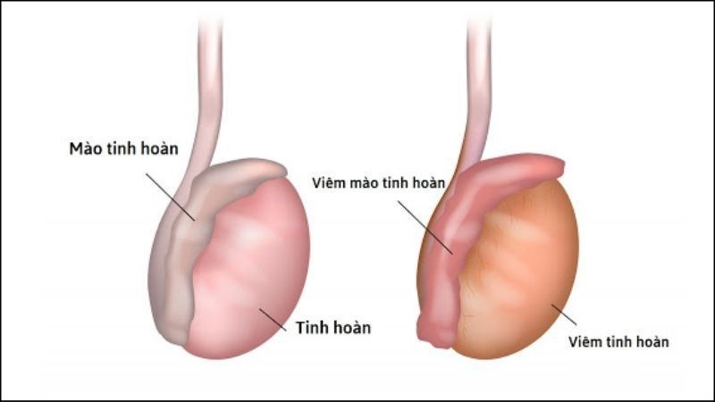 Bài thuốc chữa viêm tinh hoàn do bệnh quai bị