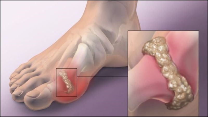 Bài thuốc trị bệnh gout từ ngũ gia bì và các dược liệu khác
