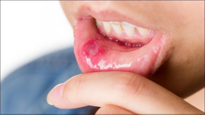 Hoàng liên có thể được sử dụng để trị nhiệt miệng