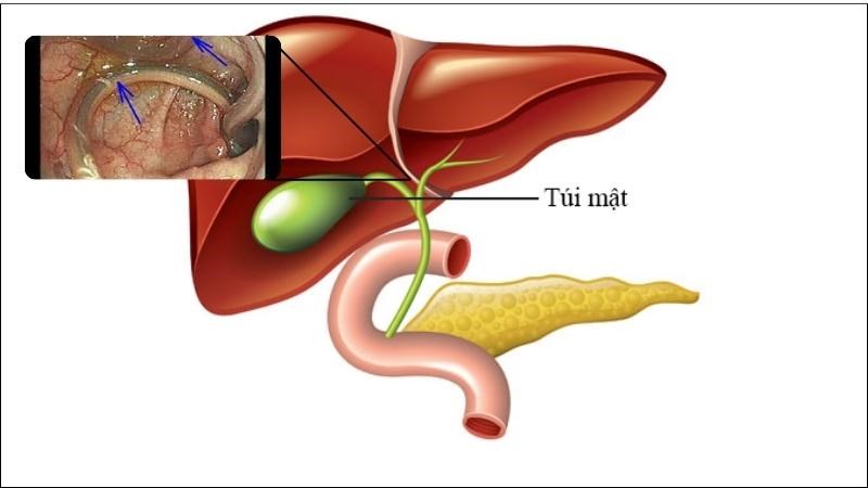 Hoàng liên có thể được kết hợp với các vị thuốc khác để trị tình trạng giun chui ống mật