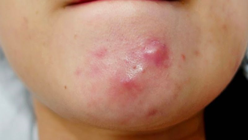 Mụn trứng cá có thể được điều trị bằng giác hơi