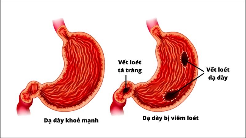 4. Lựa Chọn Thuốc Dạ Dày Phù Hợp Dựa Trên Tình Trạng Cụ Thể