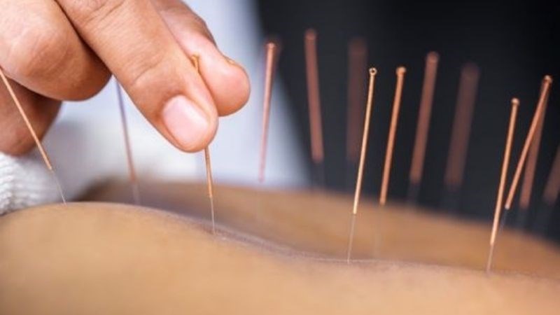 Châm cứu giúp lưu thông các dòng máu trong cơ thể