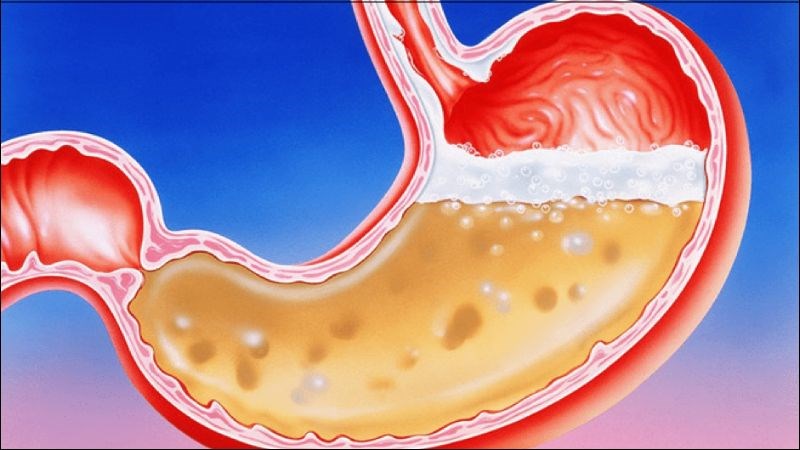 Triệu chứng đau dạ dày có thể thuyên giảm khi sử dụng đều đặn nước lá đu đủ