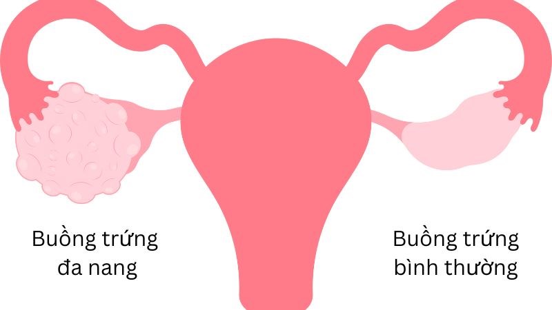 Buồng trứng đa nang là nguyên nhân chính gây vô sinh nữ giới