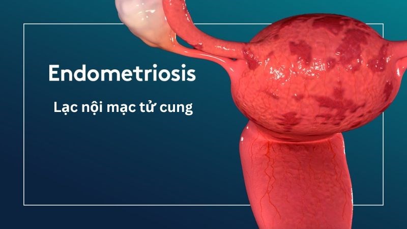 Lạc nội mạc tử cung làm ảnh hưởng đến chất lượng của trứng hoặc tinh trùng
