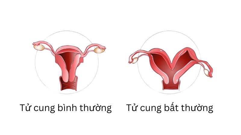 Tử cung bất thường làm giảm khả năng mang thai 