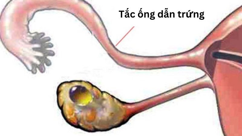 Tổn thương ống dẫn trứng làm giảm khả năng di chuyển của tinh trùng