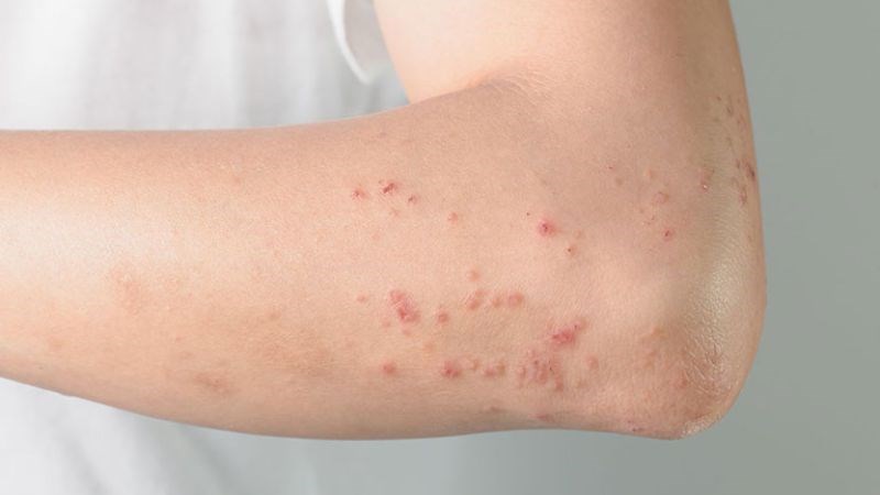 Rau đắng đất có thể hỗ trợ điều trị các bệnh về da