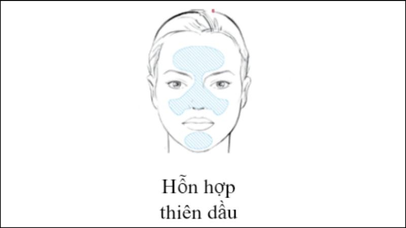 Da hỗn hợp thiên dầu thường tiết nhiều dầu ở vùng chữ T