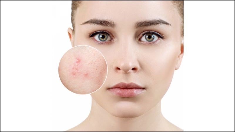 Cần chú ý trong việc lựa chọn sản phẩm tẩy trang để tránh gây kích ứng cho da