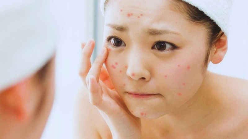 Ăn quá nhiều bánh pía khiến thúc đẩy quá trình viêm trên da, từ đó dễ gây nổi mụn